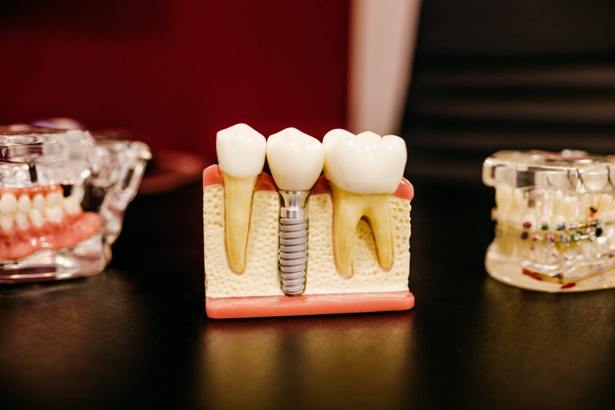 tooth-implant-1200x800.jpg