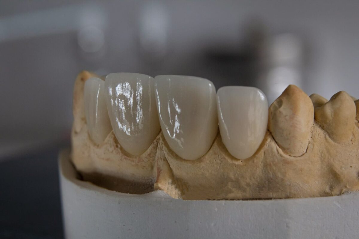 Porcelain-teeth-1200x800.jpg